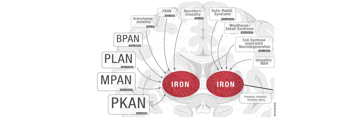 Neurodegeneration with Brain Iron Accummulation